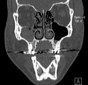 CT-scan: coronale weergave die verplaatsing van zacht weefsel binnen de sinus maxillaris laat zien.