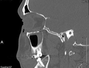 Tomografía computarizada postoperatoria: vista sagital que muestra el reposicionamiento de los tejidos blandos en un suelo orbitario y una buena adaptación de la malla de titanio.