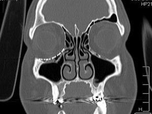 Tomografía computarizada postoperatoria: vista coronal que muestra el reposicionamiento de los tejidos blandos en un suelo orbitario y una buena adaptación de la malla de titanio.