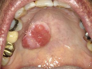 Exame físico intraoral, mostrando lesão nodular pediculada, recoberta por mucosa exibindo áreas de ulceração, no palato duro.
