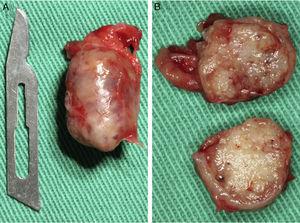 Peça cirúrgica íntegra (A) e após secção transversal (B), mostrando presença de cápsula.