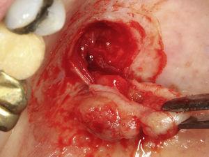 Excisão cirúrgica da lesão que se encontrava aderida à mucosa.