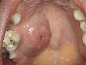 Exame físico intraoral, mostrando aumento de volume no palato duro, com área de ulceração.