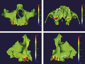 Mapa por código de cores do tratamento com o aparelho mini‐Hyrax invertido com BTP. O vermelho nos pré‐molares, no canino do lado direito e o amarelo em corpo maxilar do lado direito indicam expansão. O verde nos molares indica ausência de mudança nessa região.