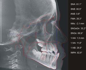 Radiografia e cefalograma em norma lateral da face, do paciente B, antes da instalação do aparelho mini‐Hyrax invertido com BTP.