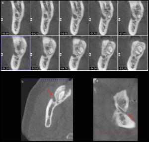 Parasagital view (a), axial view (b) e sagital view (c) da fenestração do canal mandibular do lado direito da mandíbula.