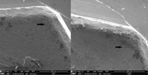 SEM image of the vertex of the implant's external hex in the Ti/Zr assembly after TCML, with 3000× magnification, showing zirconia particles (Z2).