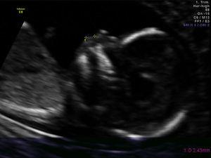 Sonographic measurement of the philtrum length at 13 weeks of gestation.