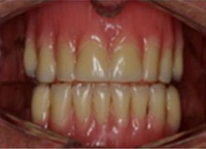 Aparelho duplo com dentes, somente para efeito estético, assentado diretamente sobre o rebordo alveolar.