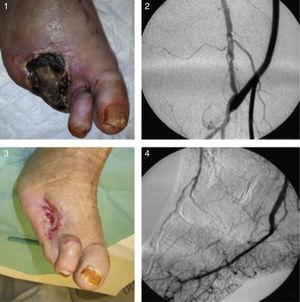 1 – Aspeto do pé antes do bypass ultradistal. 2 – Imagem angiográfica da anastomose proximal do bypass. 3 – Aspeto do pé 2 meses e meio após a cirurgia. 4 – Controlo angiográfico da anastomose distal do bypass à artéria plantar externa.