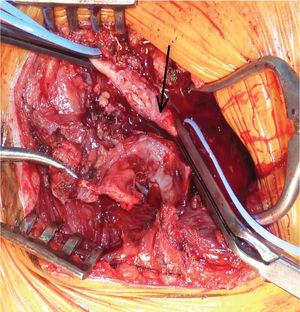 Ressecção de falso aneurisma e aspecto da artéria axilar (seta)