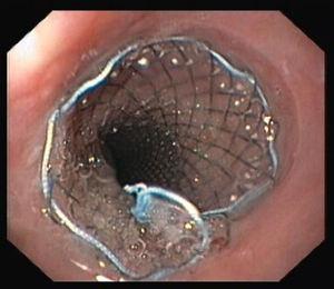 Covered self-expandable esophageal stent.