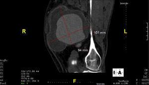 Aneurisma da poplítea, imagem da tomografia axial computorizada (TAC) em sagital.