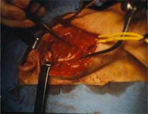 Tratamento cirúrgico de uma tortuosidade carotídea.