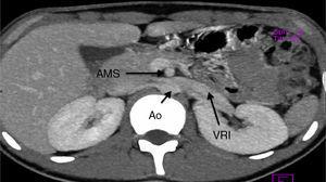 Angiotomografía renal. Se observa aumento del diámetro de la vena renal izquierda. AMS: arteria mesentérica superior; Ao: aorta; VRI: vena renal izquierda.