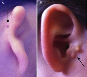 Tipos de microtia-atresia. A) Tipo iii con hoyuelo auricular (flecha). B) Tipo i con apéndices preauriculares (flecha).