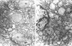 A. Tres hepatocitos con aumento en el número de mitocondrias. B. Acercamiento del citoplasma donde se observa pleomorfismo de las mitocondrias con desplazamiento a la periferia de las crestas (flecha).