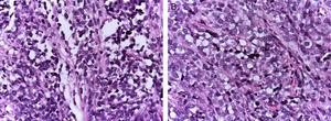 (A) Aspect histologique d'un rhabdomyosarcome alvéolaire : des septa conjonctifs fibreux forment des structures pseudo-alvéolaires, dans lesquelles sont incluses des cellules néoplasiques. (B) Dans certaines zones, elles occupent tout l'espace formant un néoplasme solide.