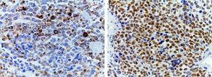 (A) Coloration immunohistochimique montrant la positivité de la desmine. Un filament intermédiaire est présent dans le cytoplasme des cellules musculaires striées associé à des bandes Z. (B) Intense positivité nucléaire pour la myoglobine, une hémoprotéine présente dans le muscle squelettique et servant de transporteur et de réservoir d'oxygène ; elle apparaît tardivement sur la maturation musculaire séquentielle et est positive dans 95% des cas de rhabdomyosarcomes.