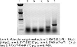 Électrophorèse sur gel d'agarose d'une RT-PCR, où figure la translocation représentative PAX3/7-FKHR du rhabdomyosarcome alvéolaire, en écartant les autres néoplasmes solides.