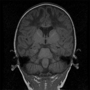 Imagen coronal T1. Ausencia de mielinización de la materia blanca, atrofia del cuerpo calloso con mielinización parcial, tallo cerebral normal. Se observa cavum septum pellucidum y cavum vergae.