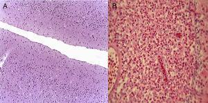 Los cortes histológicos del paciente referido muestran ausencia de infiltrado inflamatorio (A). Por el contario, se muestra el intenso infiltrado inflamatorio de leucocitos polimorfonucleares en un caso de meningitis (B).