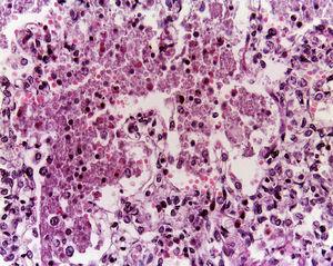 Los cortes histológicos de los pulmones muestran infiltrado inflamatorio de leucocitos polimorfonucleares y macrófagos, algunos con hemofagocitosis.