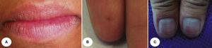 Paciente 4. Lesiones pigmentadas en bermellón, dedos y uñas.