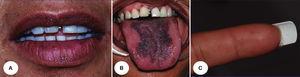 Paciente 5. A. Lesiones en labio inferior. B. Lesiones pigmentadas en lengua, y C. Máculas en dedo (madre de la paciente de la Figura 6).