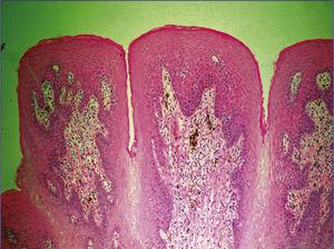 Melanosis focal con caída de pigmento en lámina propia de papila fungiforme (H&E 100x).