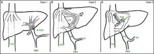 Schematic anatomy of the shunts (white arrows) in: A. Case 1-Congenital mesenterico-portal Rex shunt. B. Case 2- Type II portosystemic shunt (congenital intrahepatic portocaval shunt). C. Case 3- Type II portosystemic shunt (PDV). IVC: Inferior vena cava. R: Recessus. SV: Splenic vein. SMV: Superior mesenteric vein. LV: Ligamentum venosum. PV: Portal vein.