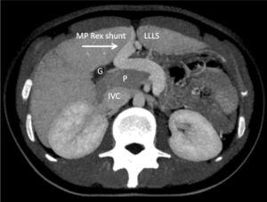 CT angiography of case 1 shows a congenital mesenterico-portal (MP) Rex shunt (arrow). LLLS: Liver's left lateral segment. G: Gallbladder. P: Pancreas. IVC: Inferior vena cava.