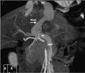 CT angiography of case 2 shows a congenital portosystemic shunt (arrow) arising from the left portal vein and diverting the flow to the inferior vena cava/right atrium. IVC: Inferior vena cava. PV: Portal vein. SMV: Superior mesenteric vein.