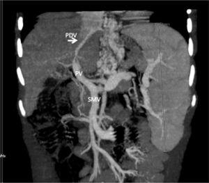 CT angiography of case 3 shows a patent ductus venosus (PDV) (arrow). PV: Portal vein. SMV: Superior mesenteric vein.