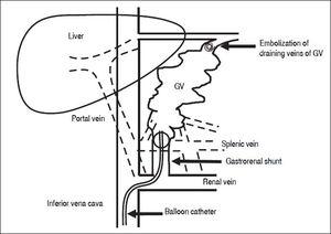 Management Of Gastroesophageal Varices In Cirrhotic Patients Current Status And Future Directions Annals Of Hepatology