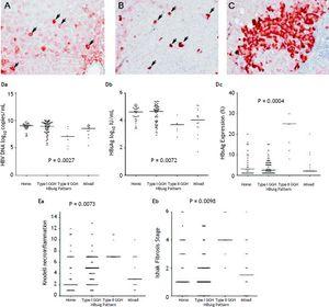 Patrones de retención de HBsAg. A. Algunos hepatocitos teñidos de HBsAg con citoplasma homogéneo de moderado a fuerte (flechas) en un fondo de hepatocitos débilmente teñidos. El núcleo de cada hepatocito teñido homogéneamente se encontraba en el centro de la célula. B. Hepatocito de vidrio deslustrado (GGH) de tipo I con densos patrones globulares o 