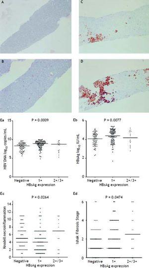 HBsAg-expresszió félkvantitatív módon, az immunjelölt sejtek aránya szerint mérve, 0-tól 3+-ig terjedő skálán, ami a vizsgált hepatociták (A) 0% (0), (B) 1-10% (C) 11-25% (2+) és (D) 25-50% (3+) pozitivitásának felel meg. A HBsAg-expressziós szint és a szérum HBV-DNS (Ea) és HBsAg-szint (Eb), valamint a Knodell-nekroinflammációs fokozat (Ec) és az Ishak-fibrózis stádium (Ed) korrelációi. A csoportok közötti összehasonlításokat Kruskal-Wallis ANOVA-val elemeztük.