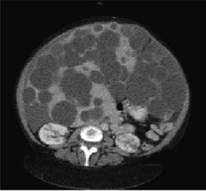 Severe polycystic liver with renal cystic disease in a middle-aged woman who ultimately underwent successful liver transplantation.