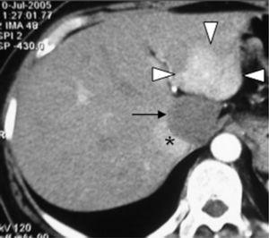 La imagen de TC con contraste obtenida durante la fase arterial temprana muestra una fuerte hiperdensidad de la lesión FNH (cabezas de flecha) respecto al hígado normal en el segmento 2. El hemangioma (flecha negra) en el segmento 1 justo adyacente al HNF no muestra realce. Vena cava inferior (*).