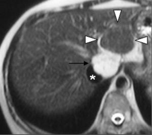 T2-vægtet HASTE MR-billede viser isointense FNH-læsion (pilespidser) i forhold til det omgivende leverparenchym. Hæmangiom (sort pil) med signalintensitet lige så stærk som den for cerebrospinalvæske ses posteriort. Vena cava inferior (*).