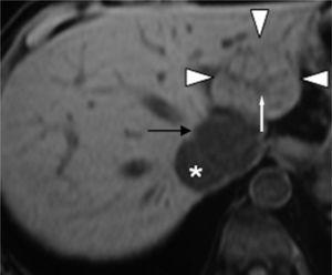 T1-gewichtete Vor-Kontrast-FLASH-3D-MR-Aufnahme zeigt isoor leicht hypointense FNH-Läsion (Pfeilspitzen). Außerdem fand sich eine hypointense lineare zentrale Narbe (weißer Pfeil) in der FNH. Das MR-Bild zeigt ein hepatisches Hämangiom (schwarzer Pfeil), das gegenüber dem umgebenden Leberparenchym hypointens ist. Vena cava inferior (*).