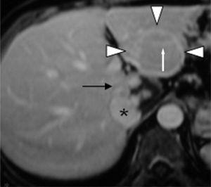  Porttilaskimovaiheen aikana otetussa gadoliniumpainotteisessa T1-painotteisessa FLASH 3D-MR-kuvauksessa näkyy FNH-vaurion isointensiivisyys (nuolenkärjet), jossa näkyy myös pseudokapselin ja sentraalisen luun arpien tehostuminen (valkoinen nuoli). Samassa kuvassa näkyy hemangiooman perifeerinen nodulaarinen täyte (musta nuoli). Vena cava inferior (*).