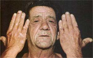Porphyria cutanea tarda - periorbital and malar violaceous coloration, hyperpigmentation and hypertrichosis on the face with bullae and scars on the dorsum of the hands (from Color Atlas & Synopsis of Clinical Dermatology, 4the, Fitzpatrick et al., with permission).