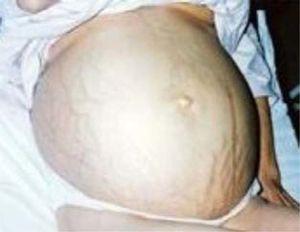 Dilated superficial veins network and stretch marks in patient with ascites.