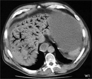 Hepatic portal venous gas | Annals of Hepatology