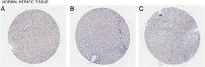 basaal expressieniveau van CD98 in normaal leverweefsel. CD98 expressie beoordeeld door immunohistochemie kleuring uit weefselmonsters (bruin). (A) vrouwelijke leeftijd 18, (B) mannelijke leeftijd 40, (C) mannelijke leeftijd 47.