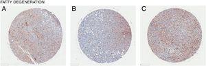 CD98-upregulatie in leverweefsel met vetdegeneratie (steatose). CD98 expressie beoordeeld door immunohistochemie kleuring uit weefselmonsters (bruin). (A) Man Leeftijd 56, (B) Man Leeftijd 55, (C) Vrouw Leeftijd 69.