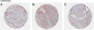 CD98-upregulatie in leverweefsel met cirrose. CD98 expressie beoordeeld door immunohistochemie kleuring uit weefselmonsters (bruin). (A) vrouw leeftijd 60, (B) vrouw leeftijd 26, (C) Man Leeftijd 57.