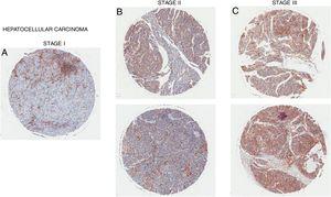 CD98-upregulatie in leverweefsel met hepatocellulair carcinoom. CD98 expressie beoordeeld door immunohistochemie kleuring uit weefselmonsters (bruin). (A) man 65 jaar, (B) vrouw 35 jaar (boven), vrouw 55 jaar (onder), (c) man 58 jaar (boven), man 41 jaar (onder).