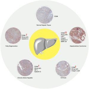 samengevatte gebieden CD98 betrokkenheid bij leverziekte. CD98 expressie beoordeeld door immunohistochemie kleuring van weefsel monsters (van eerdere cijfers) en upregulation wordt aangegeven door .